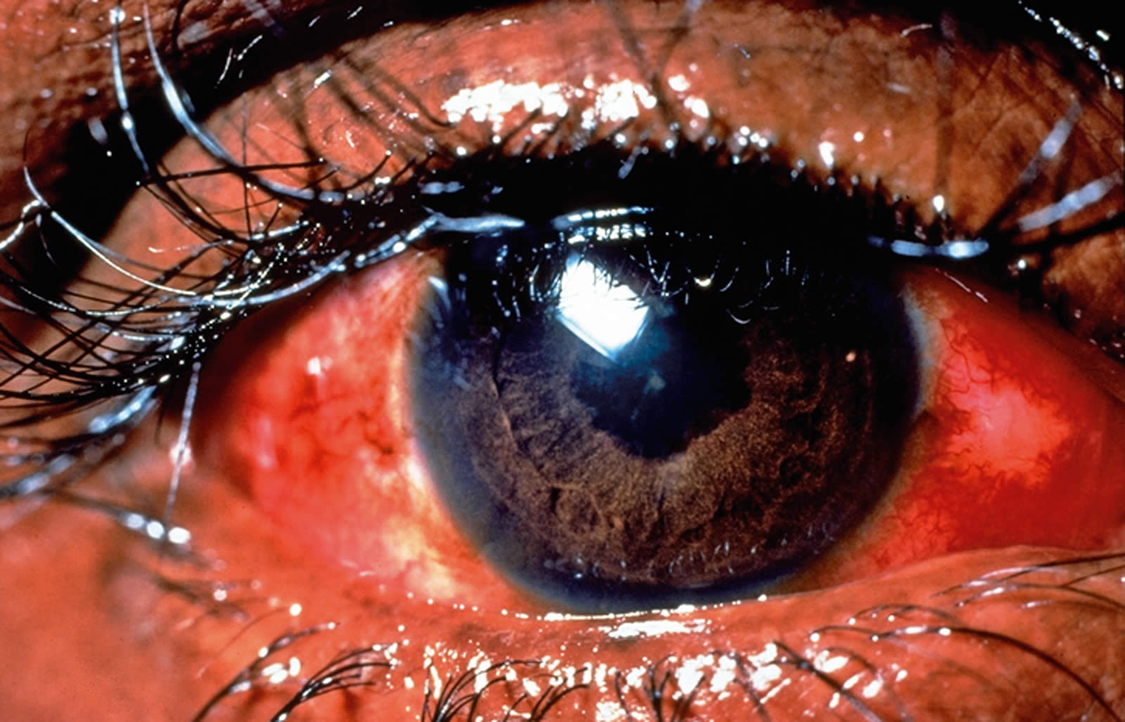 درمان قرمزی چشم