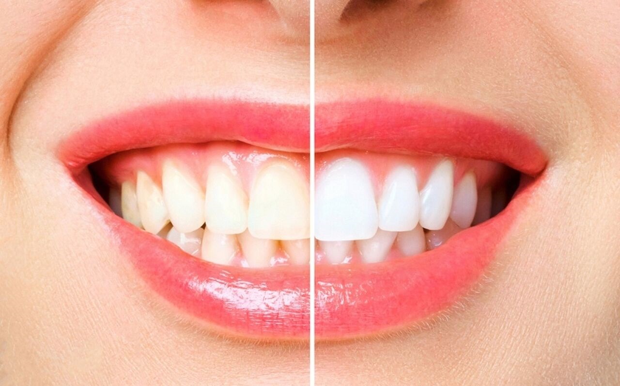 اصلاح لبخند - از بین بردن زردی دندان