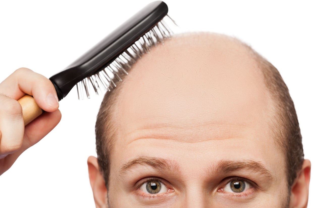 کچلی - درمان سریع ریزش مو