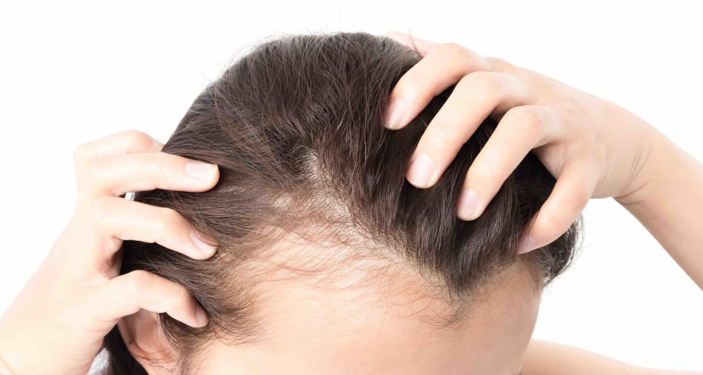 پیشگیری از ریزش مو - درمان سریع ریزش مو