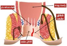 سریع و با حداقل درد و خونریزی از شر شقاق راحت شو!