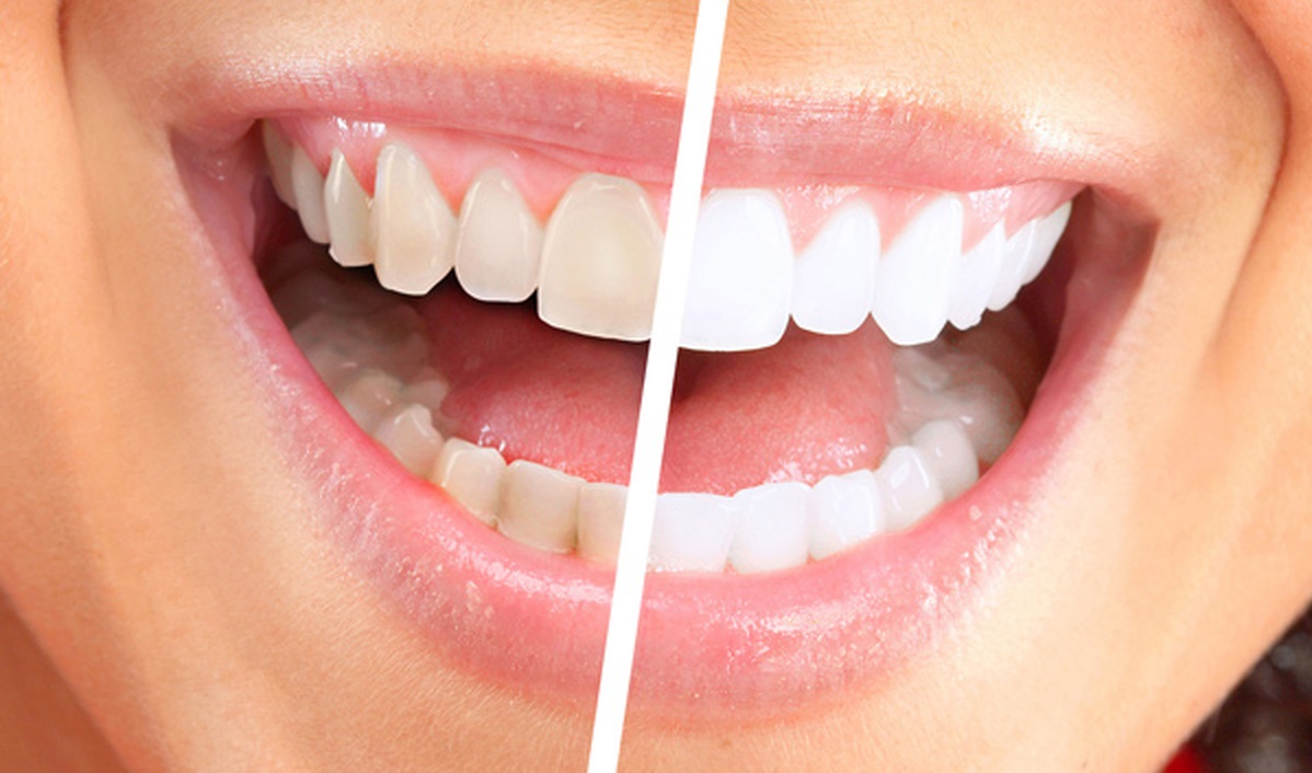 زردی دندان بر اثر سیگار - از بین بردن زردی دندان