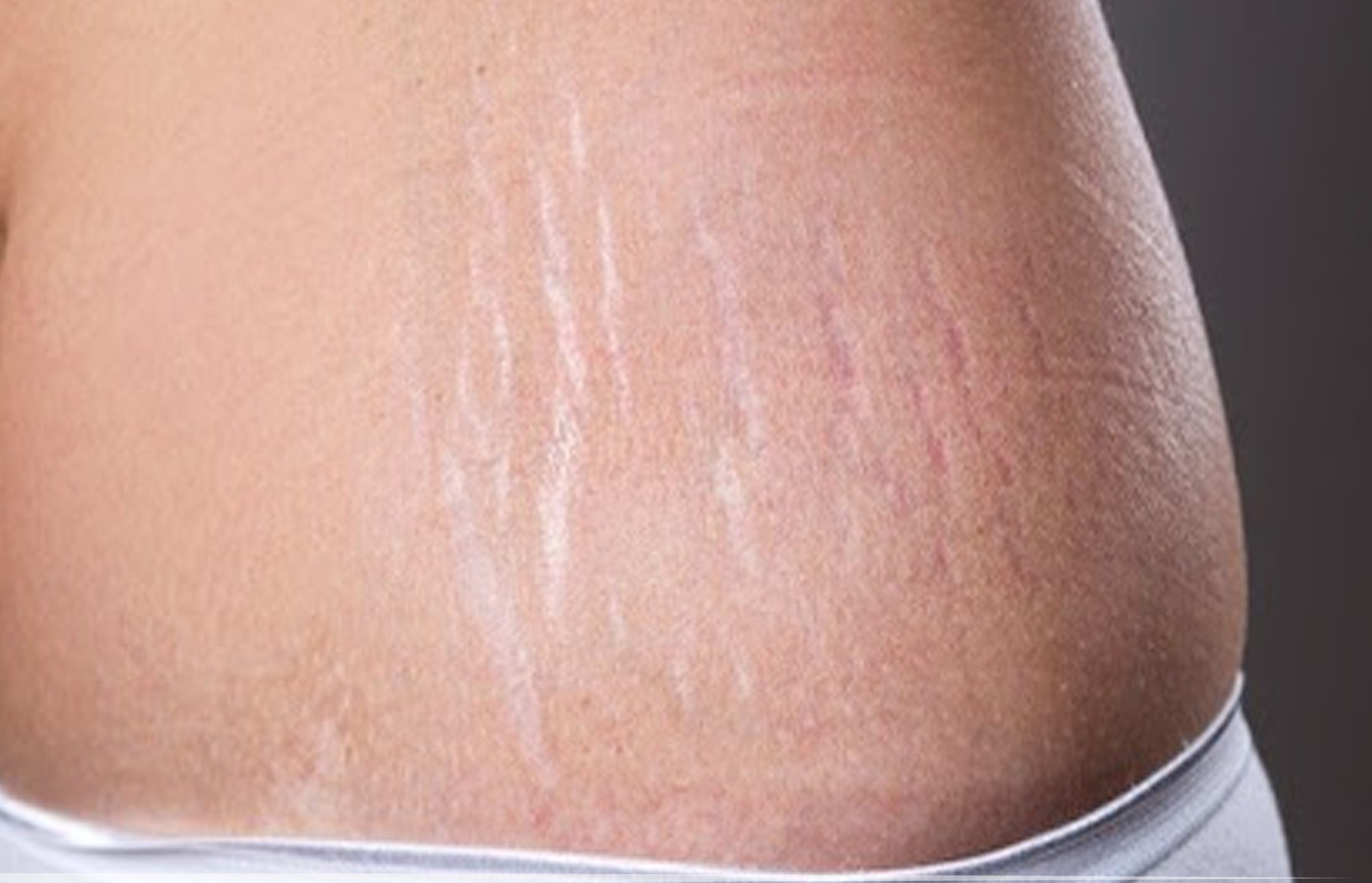 سلولیت چیست - درمان ترک پوستی