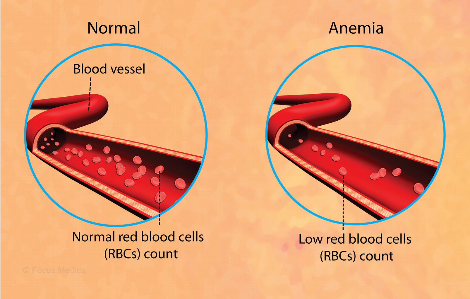 اقدامات ضروری برای درمان کم خونی چیست؟