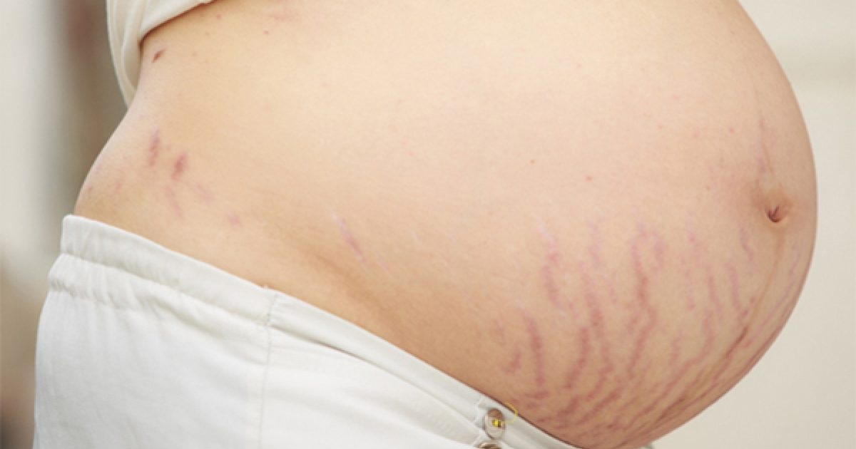 درمان ترک پوستی در بارداری