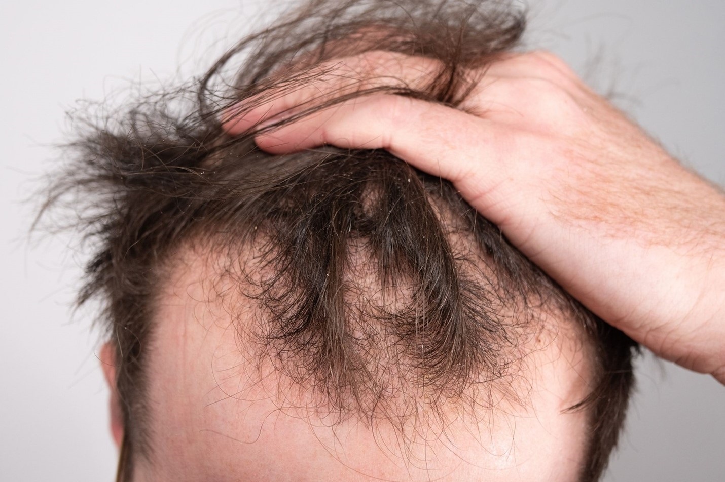 کم پشت شدن جلو موی مردان - درمان سریع ریزش مو