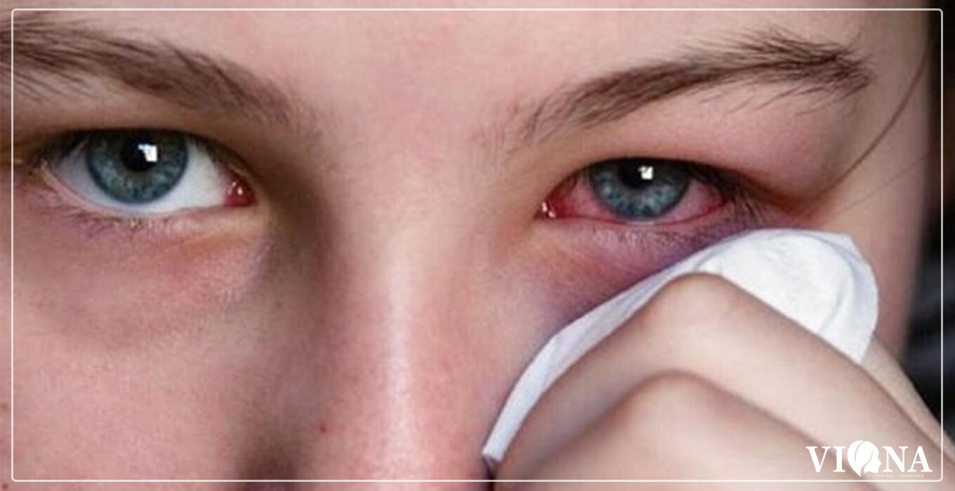 خطر آرایش - آسیب چشمی