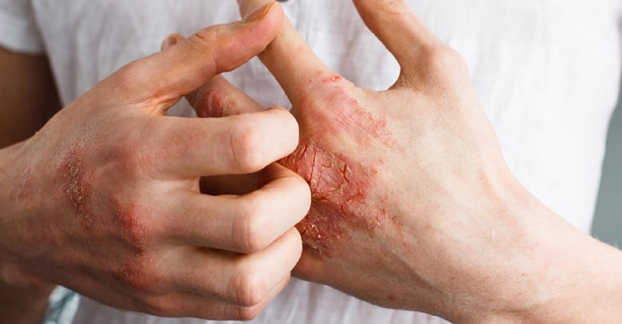 پوست پوست شدن دست - درمان خشکی پوست دست