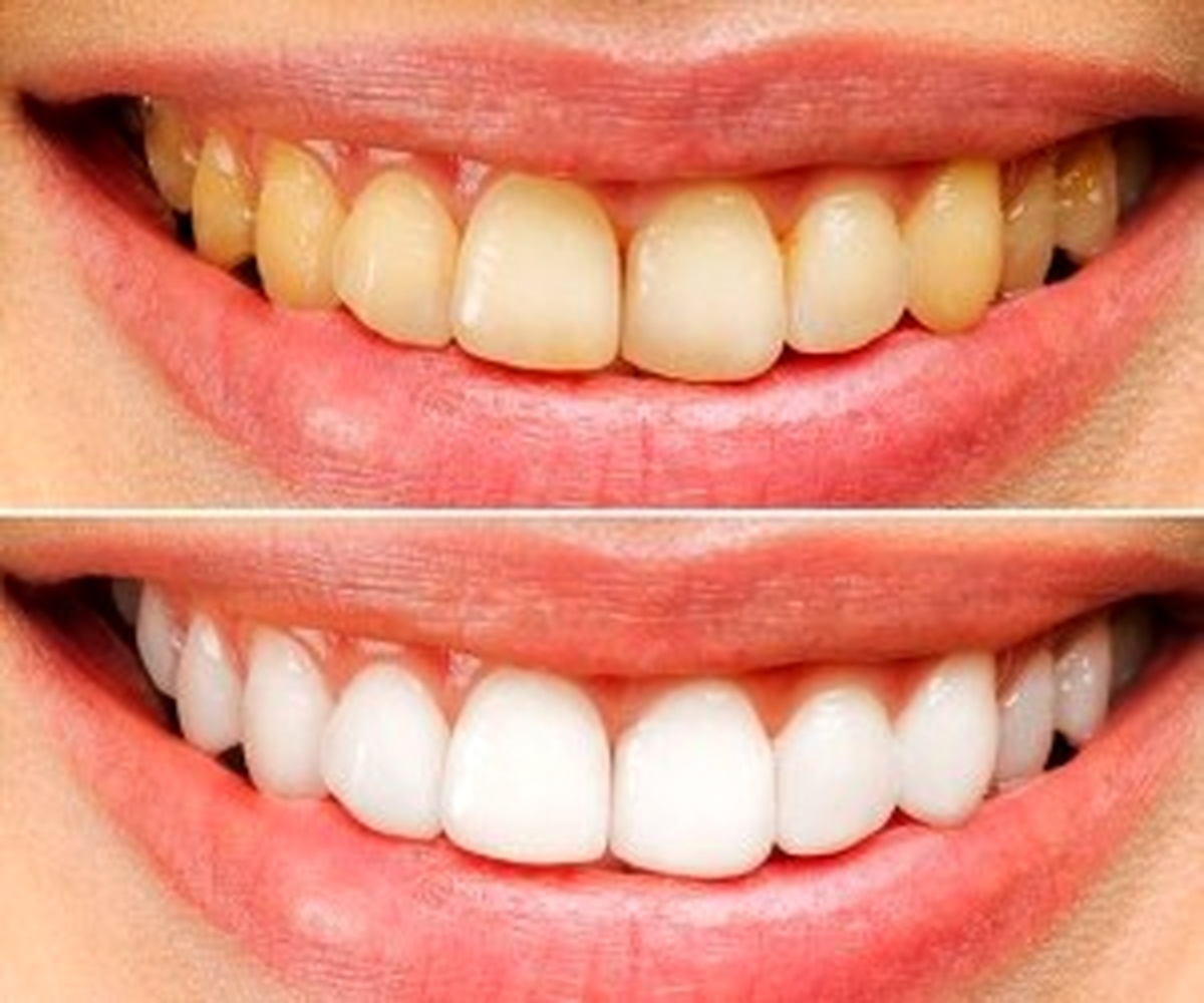 جرم گیری دندان در خانه - دندان زرد