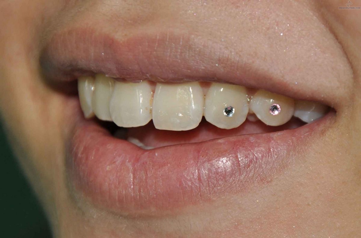 انواع پیرسینگ - پیرسینگ دندان