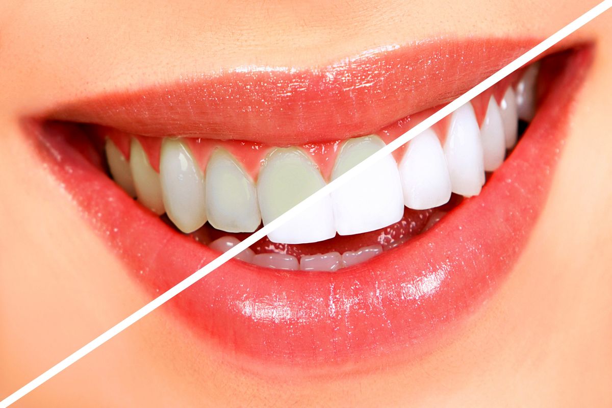 جرم گیری دندان در خانه - دندان سفید شده