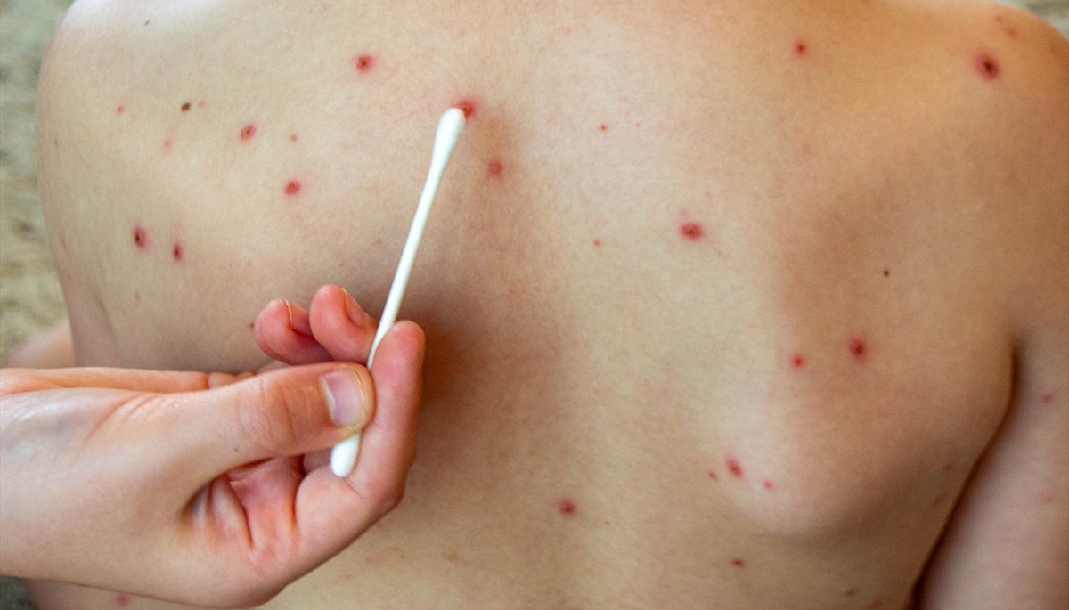 تشخیص جوش های آبله مرغان - درمان خانگی آبله مرغان