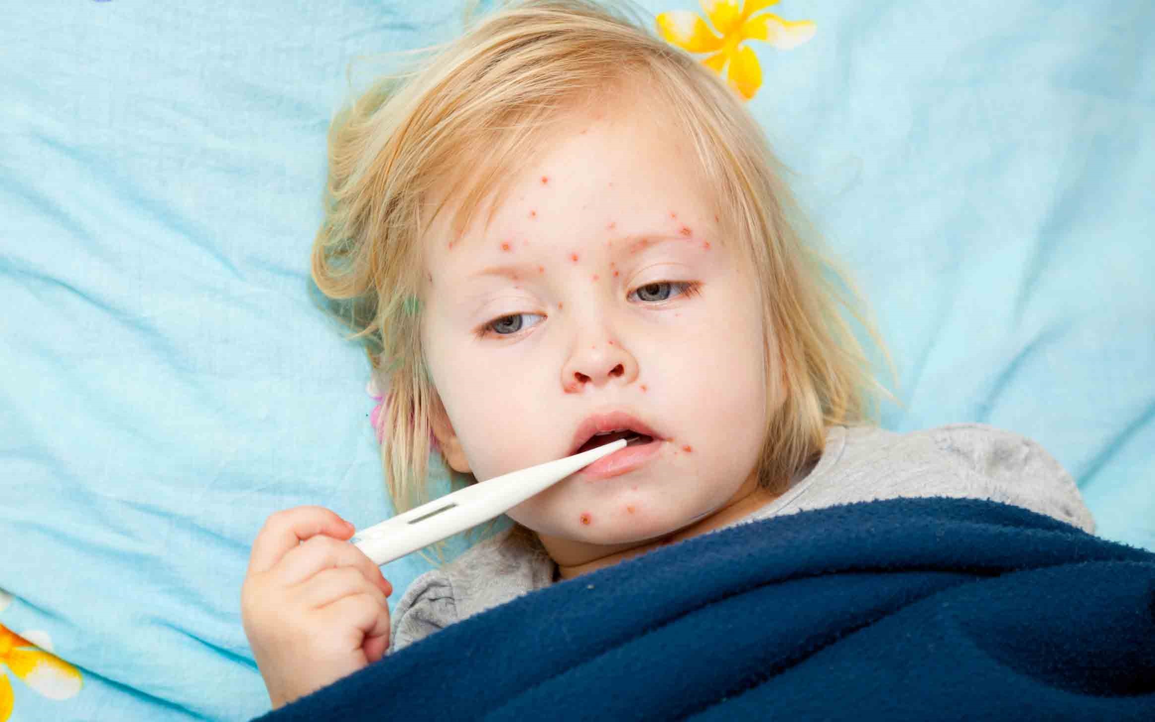 آبله مرغان کودکان - درمان خانگی آبله مرغان