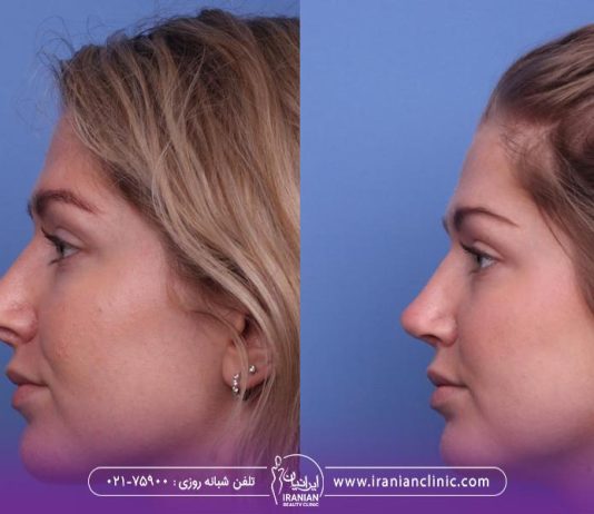 نحوه خوابیدن بعد از عمل بینی چگونه است ؟