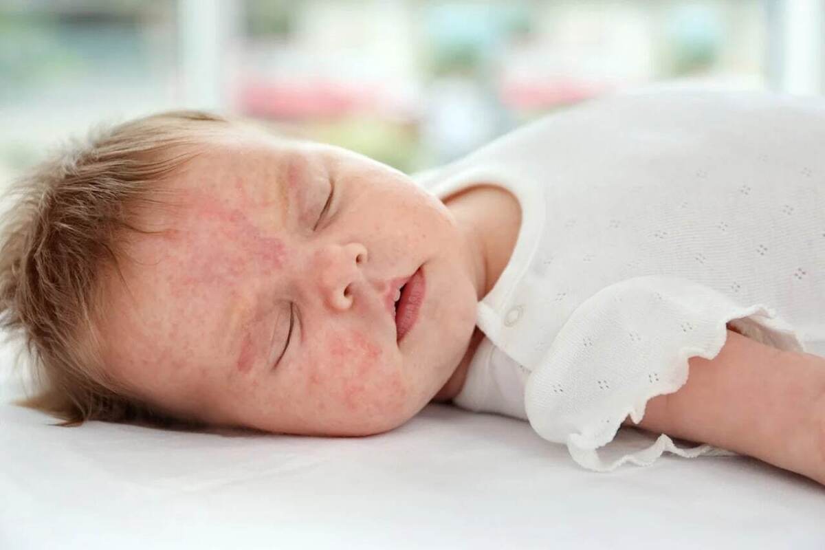 حساسیت به شیر - نوزاد با لباس سفید