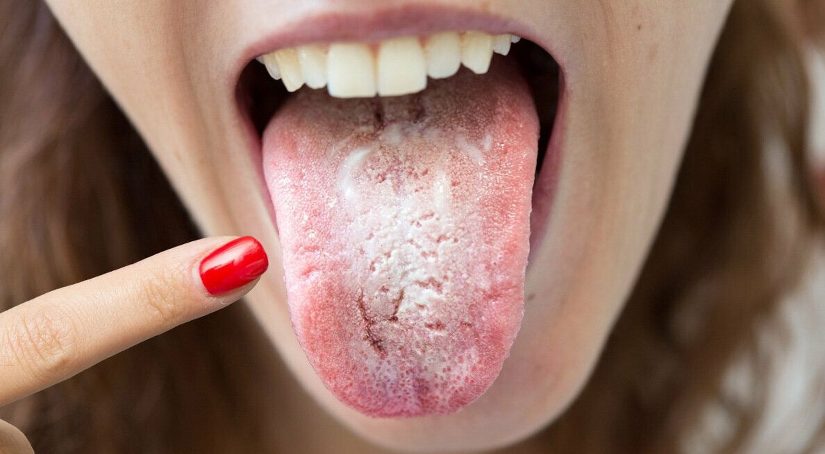 سفیدک زدن زبان - علت جوش زبان