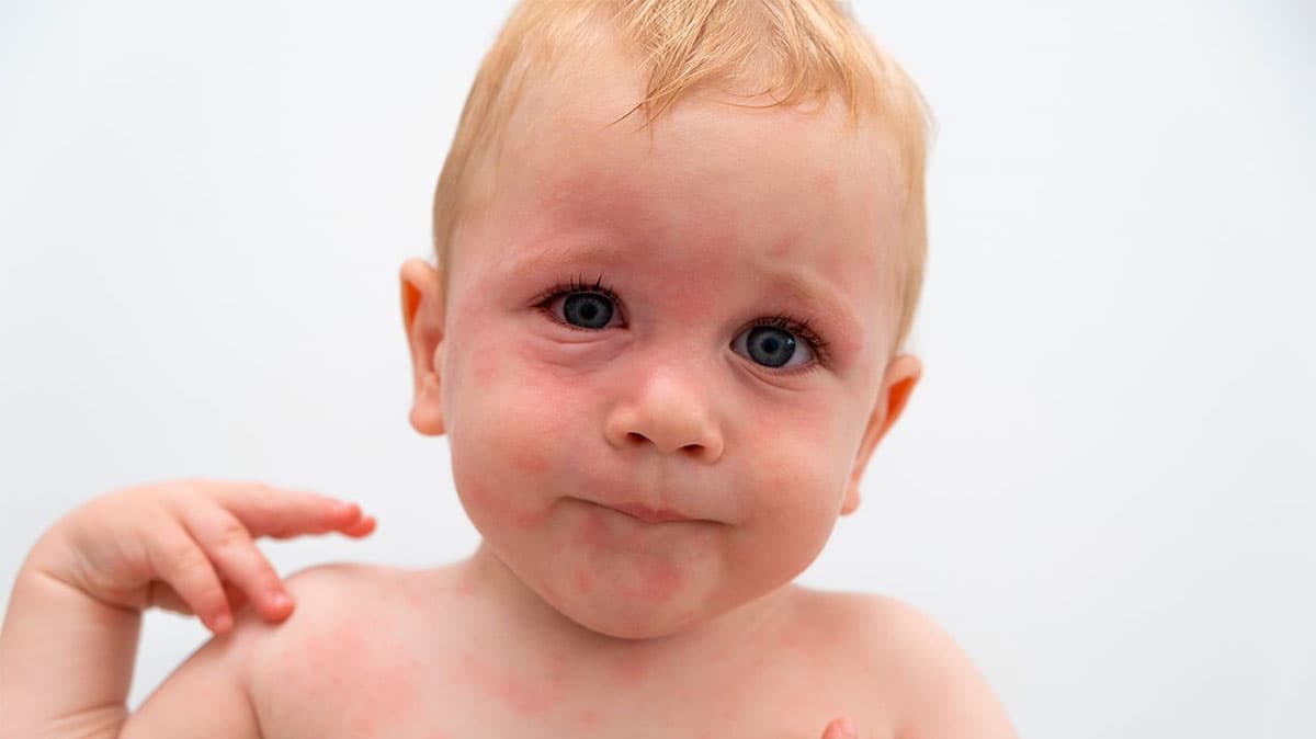 حساسیت به شیر - کودک