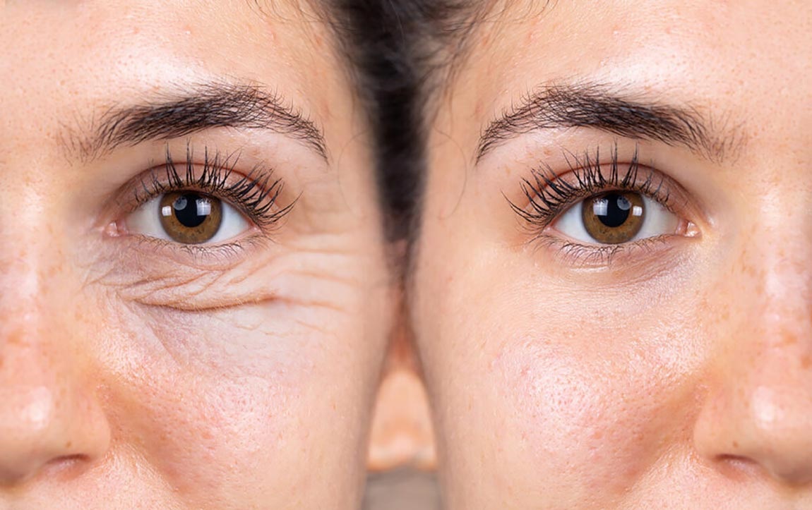 درمان چروک زیر چشم - درمان افتادگی پوست صورت در خانه