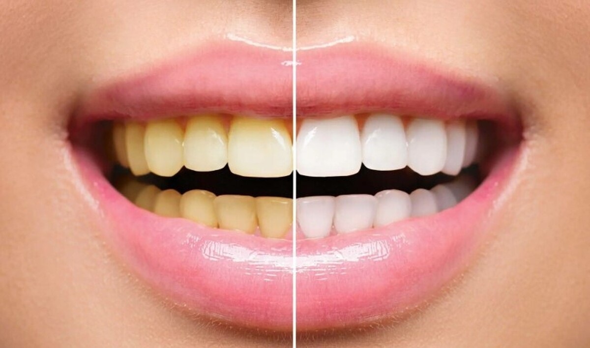 سفید کردن دندان به صورت طبیعی