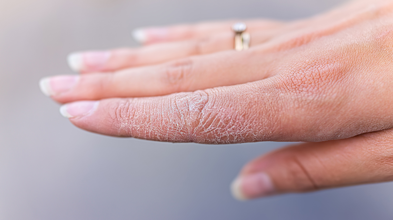 اگزمای انگشت دست - درمان خشکی پوست در زمستان