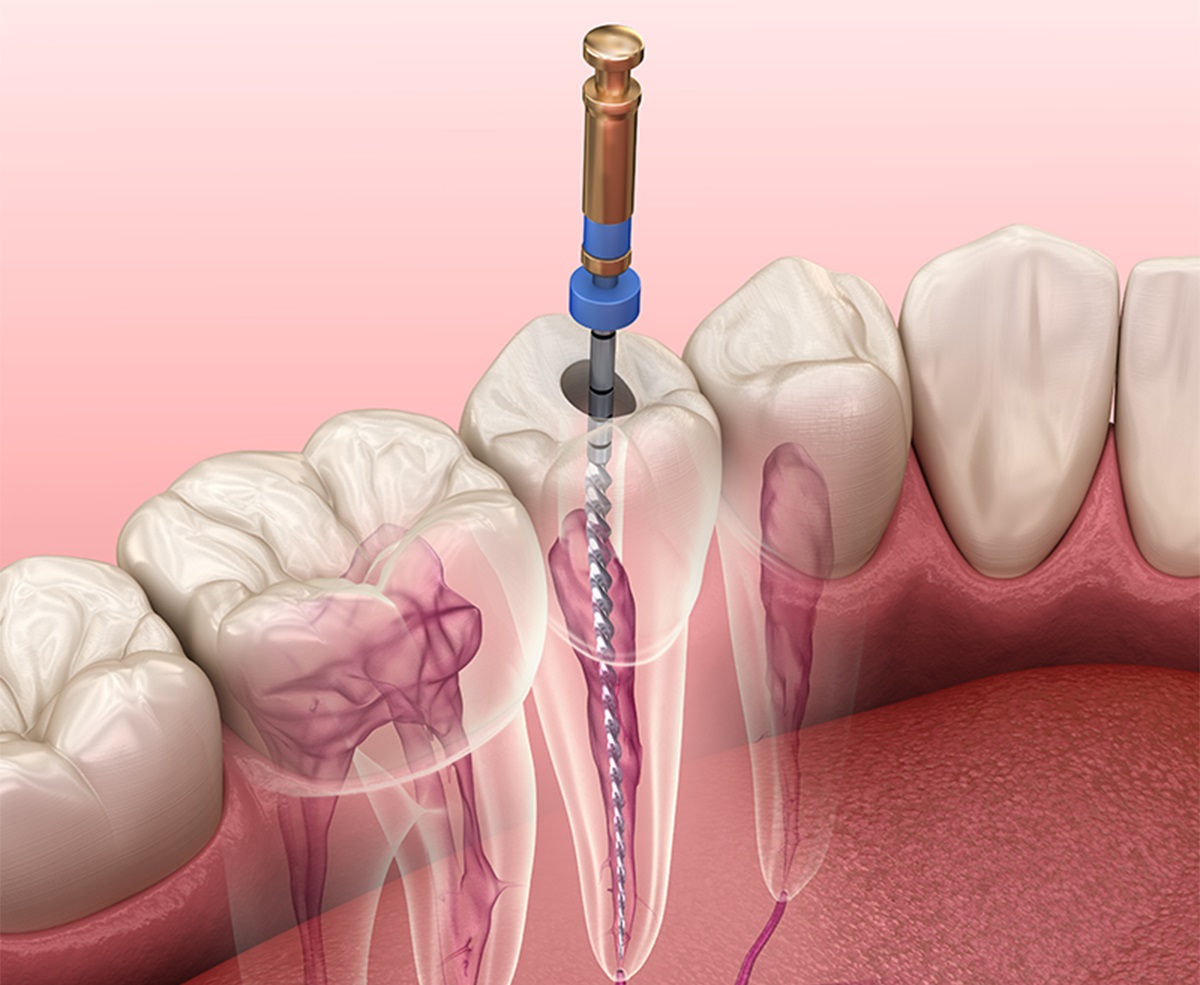 عصب کشی دندان - درد دندان عصب کشی شده