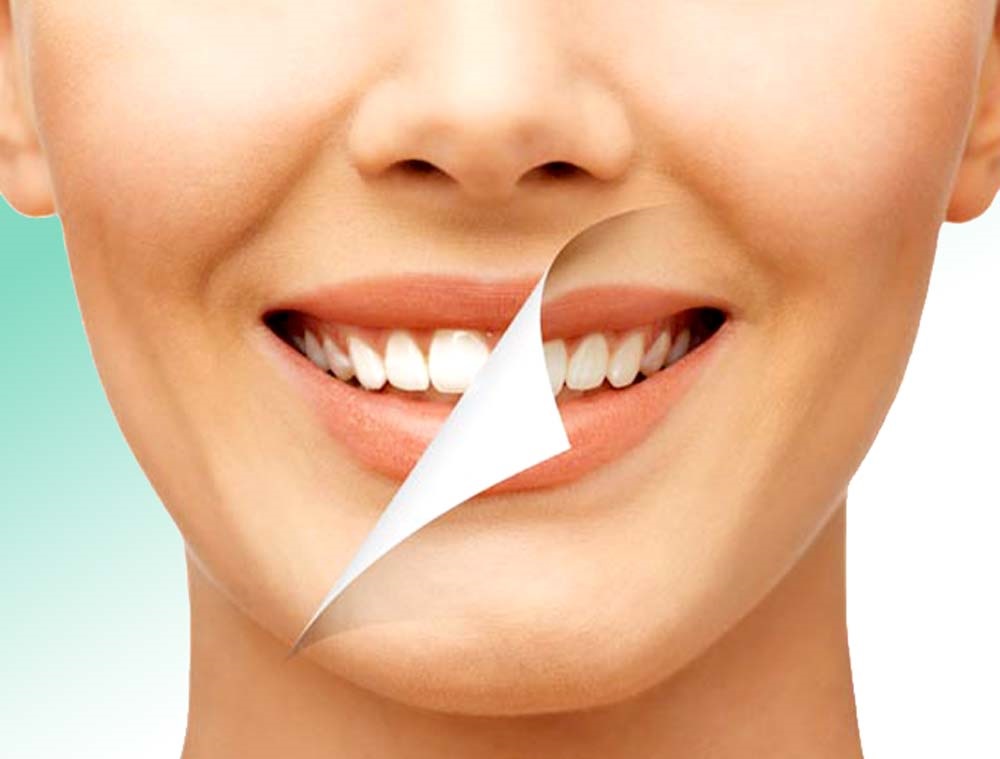 رفع زردی دندان - سفید کردن دندان