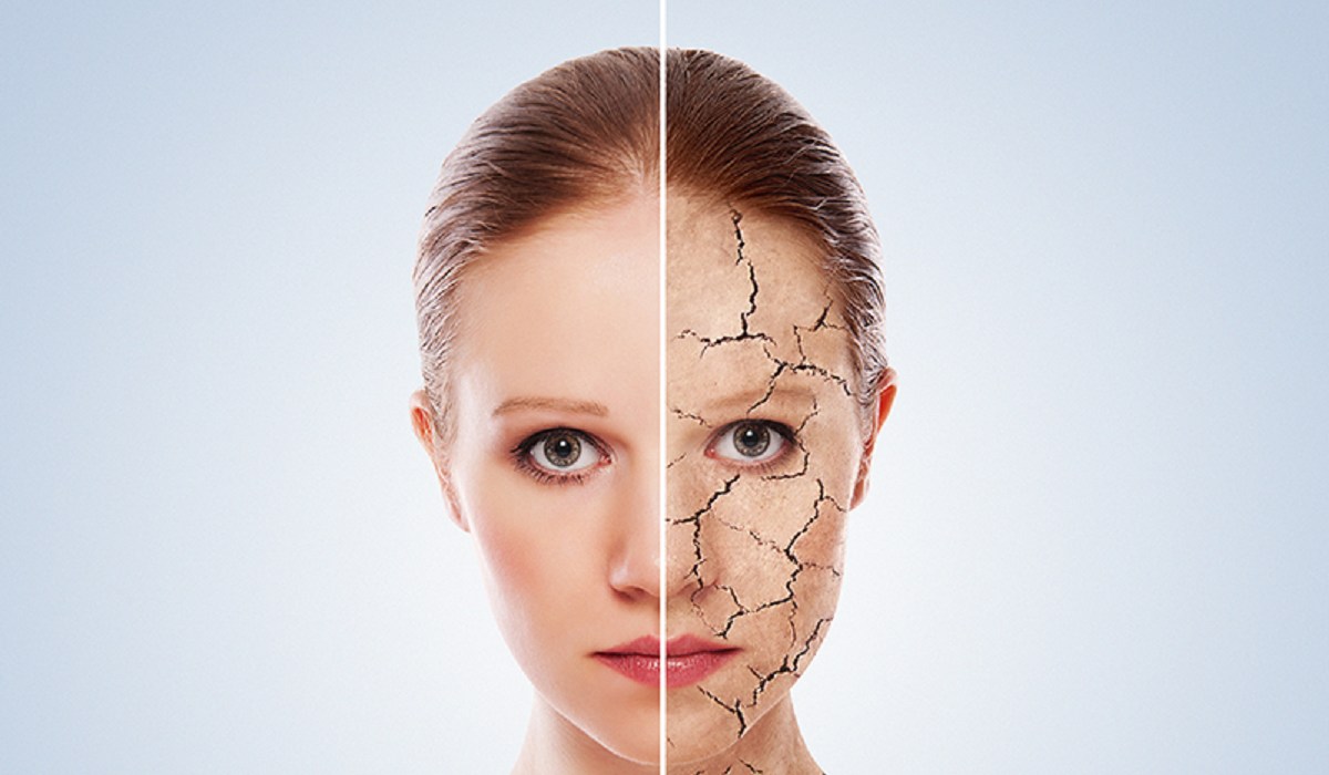 خشکی پوست صورت - درمان خشکی پوست در زمستان