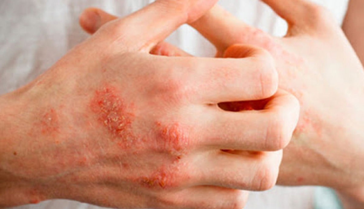 اگزمای پوست دست - درمان اگزما با عسل