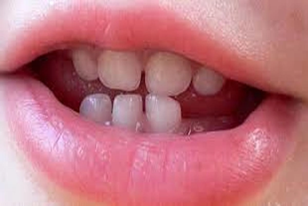 دندان شیری - لب