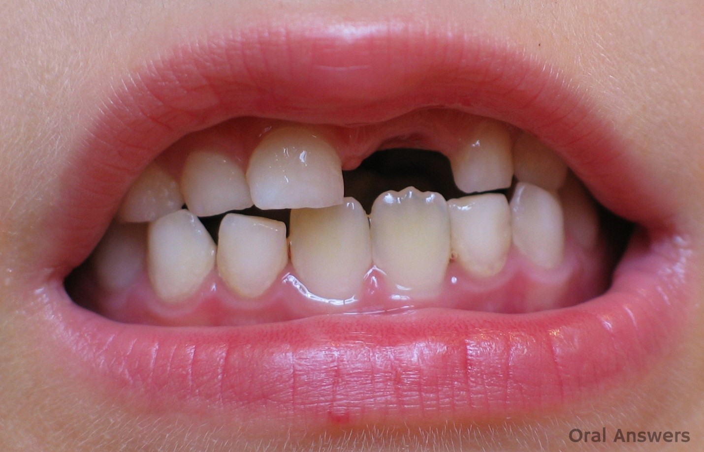 دندان شیری - دندان