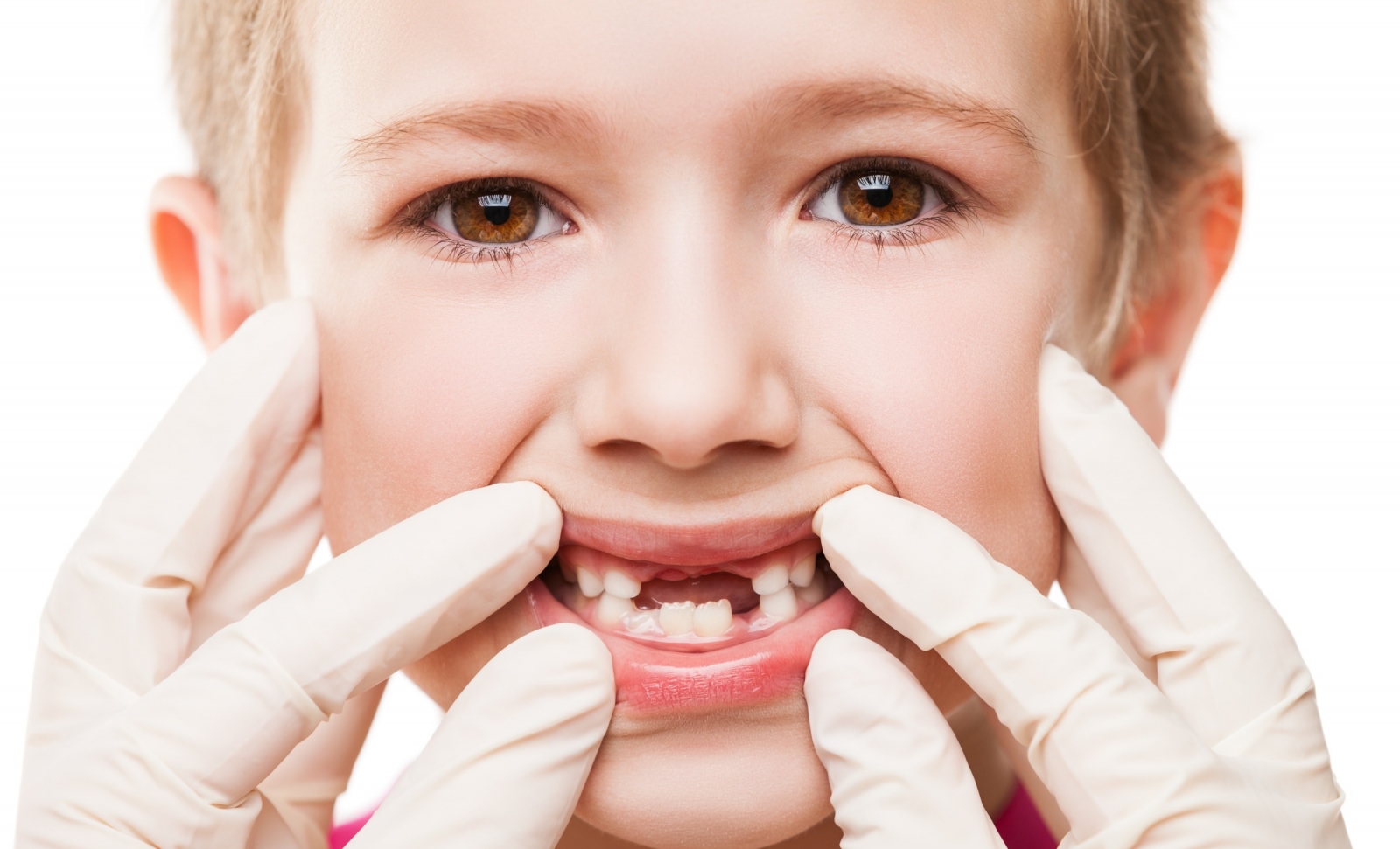 دندان شیری - کودک