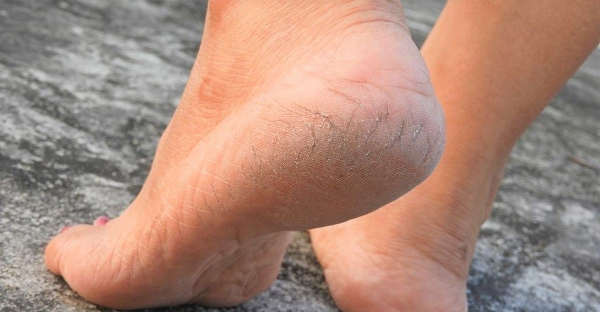 درمان ترک پاشنه پا با روش طبیعی