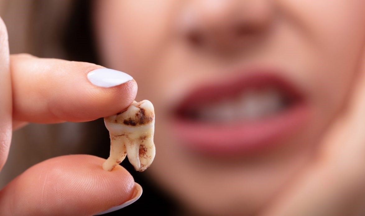 کشیدن دندان آسیاب - کشیدن دندان