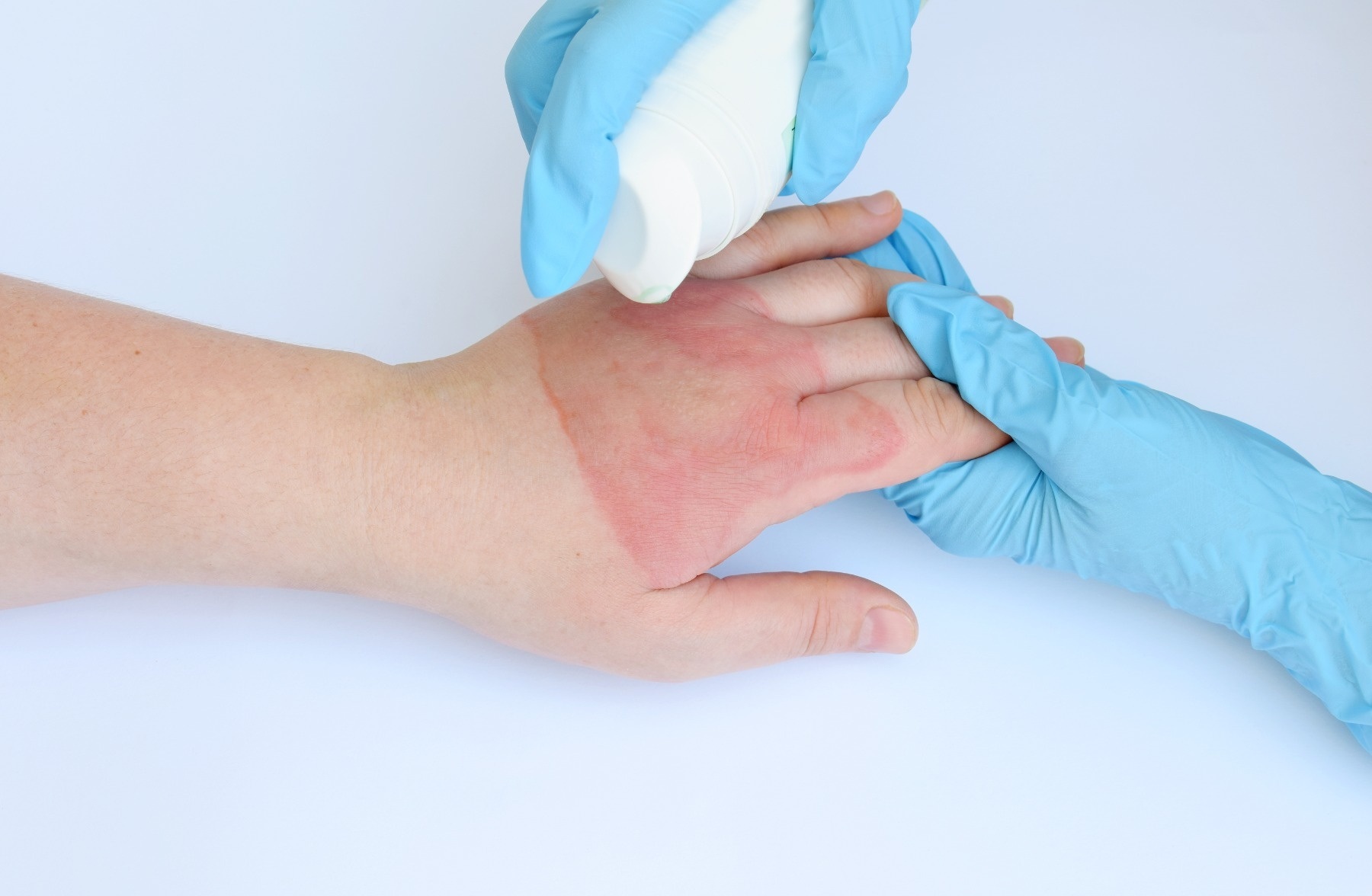 سوختگی دست - درمان سوختگی پوست
