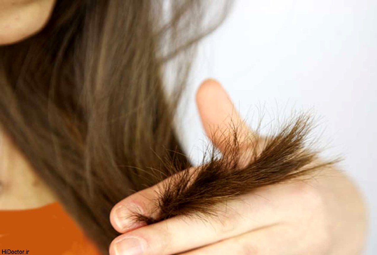 مو خوره ی شدید - درمان موخوره بدون کوتاهی