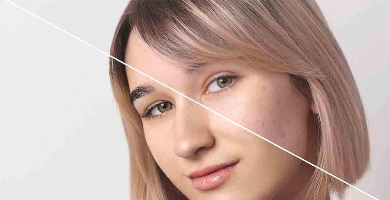 درمان جوش صورت - علت جوش پیشانی