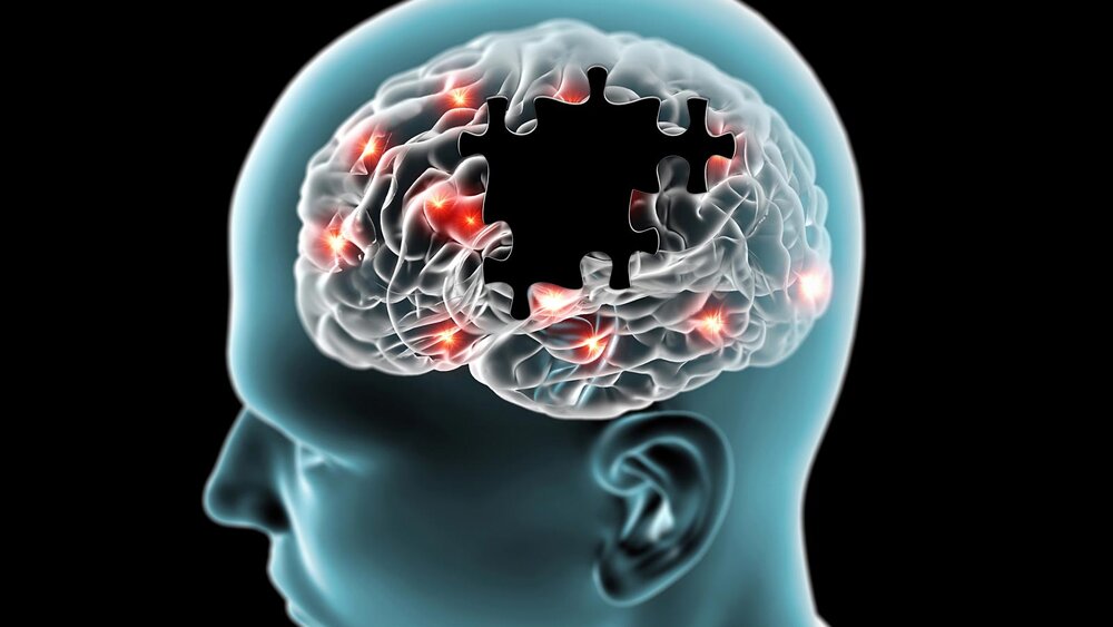علائم آلزایمر - مغز