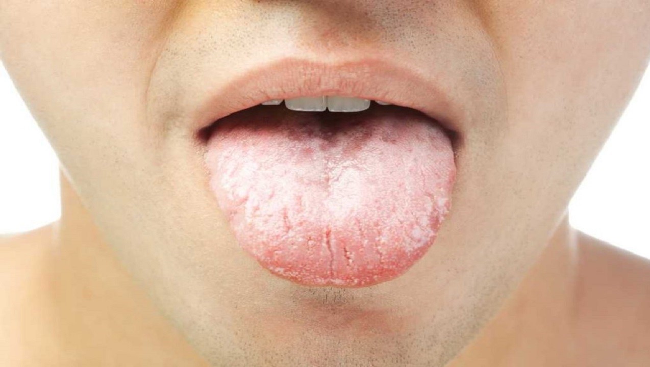 ترک خوردگی زبان - خشک شدن دهان