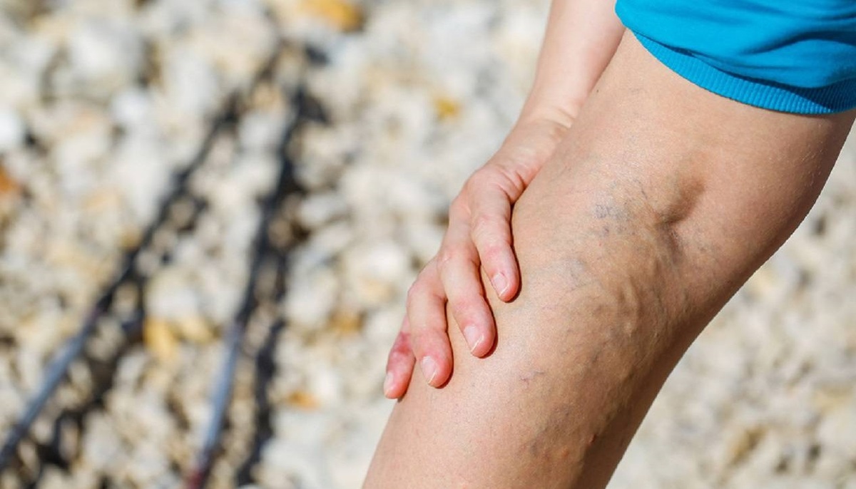 درمان واریس پا با طب سنتی - واریس ساق پا