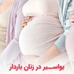 بواسیر در بارداری