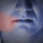 سریعترین راه های درمان ورم بعد از ایمپلنت دندان